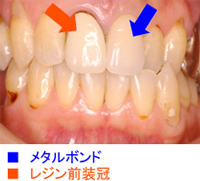 メタルボンド